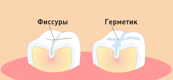 Лечение фиссура