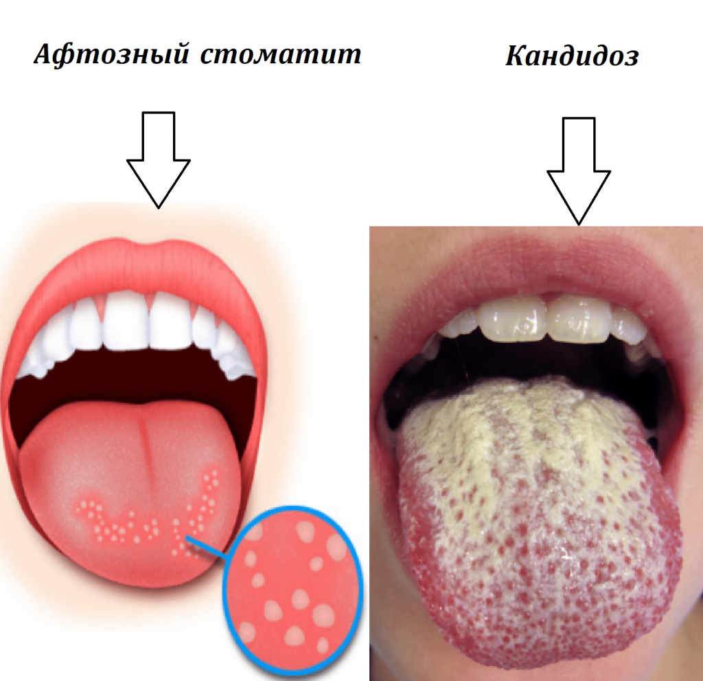 Внешние причины, почему может печь во рту